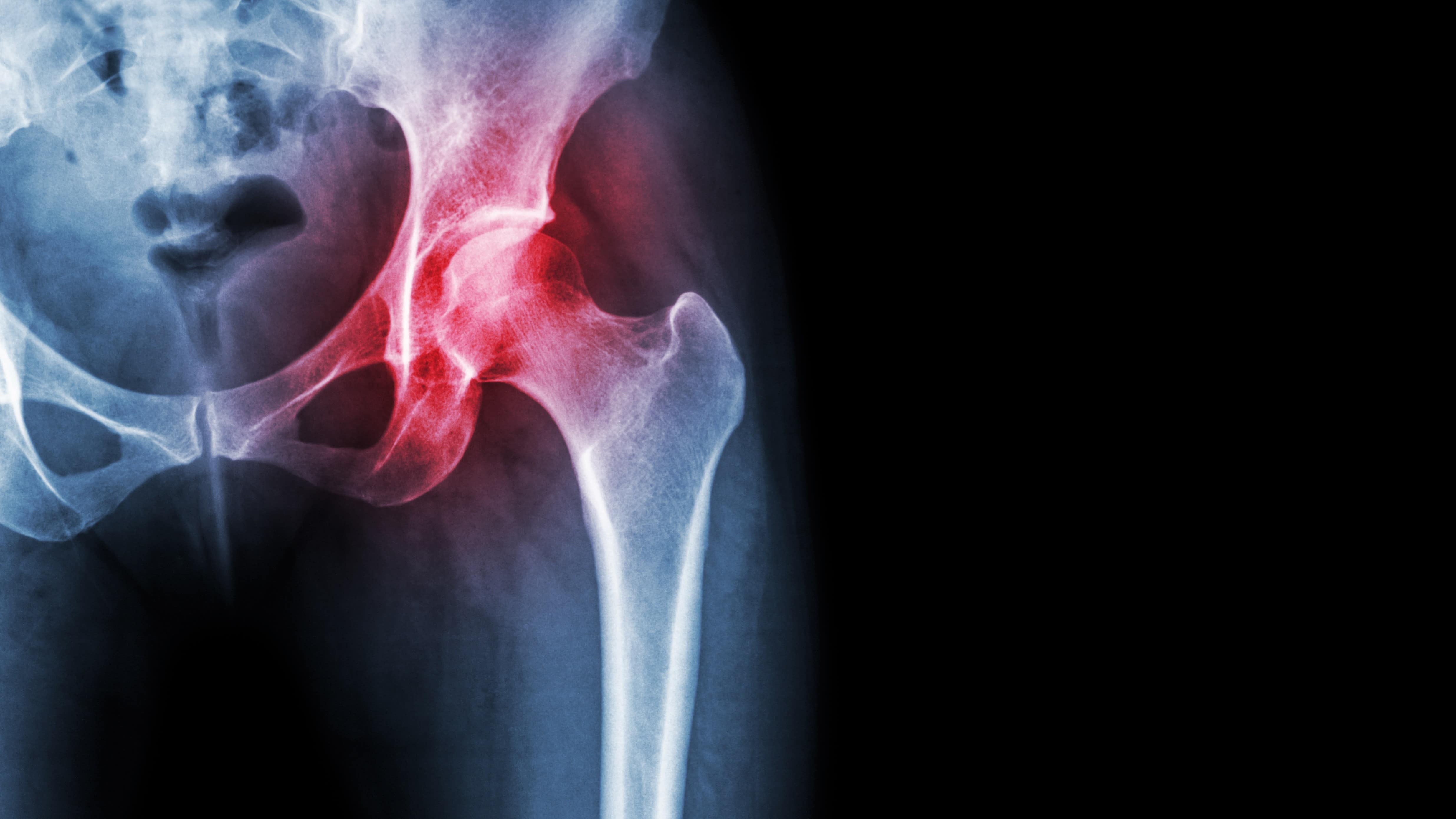 Artrosi dell'anca - protesi Dott. Paolo Lucci