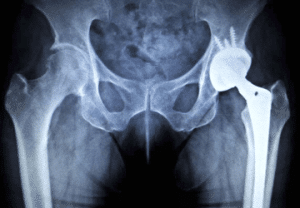 protesi dell'anca
