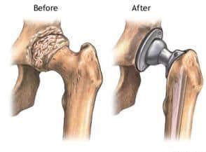 protesi dell'anca