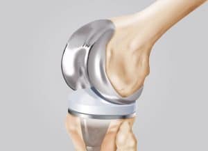 gonartrosi - protesi al ginocchio - dott. paolo lucci