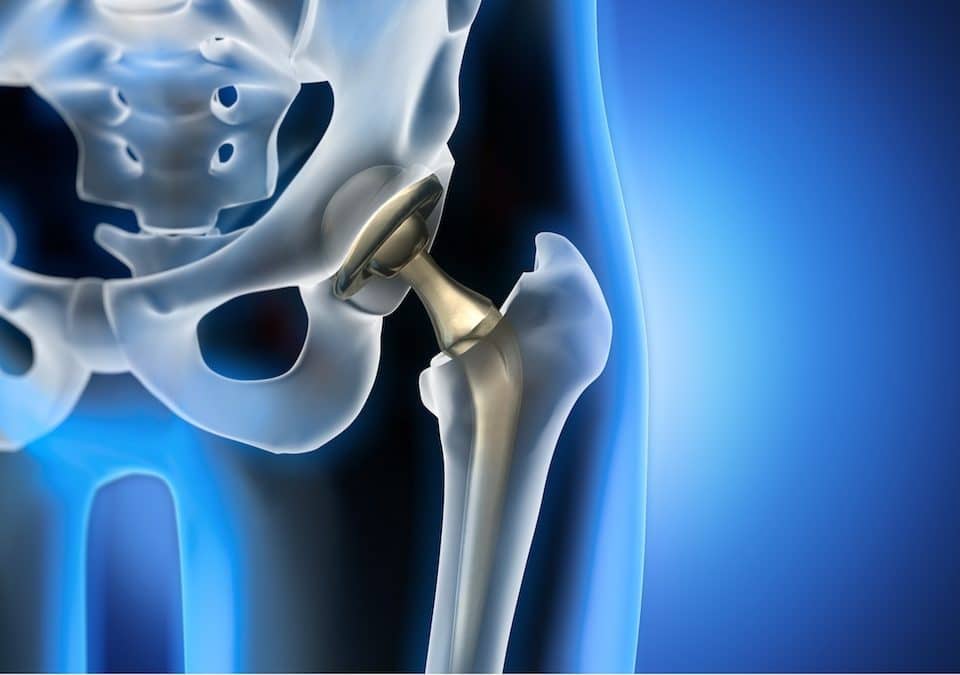 ortopedico protesi anca