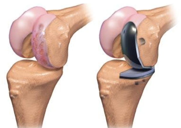 ortopedico protesi ginocchio