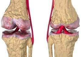 Intervento di protesi al ginocchio