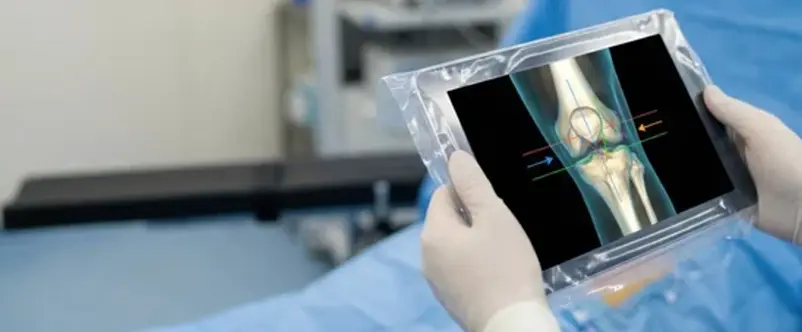 allineamento cinematico ginocchio