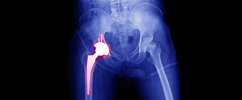 artroprotesi di anca