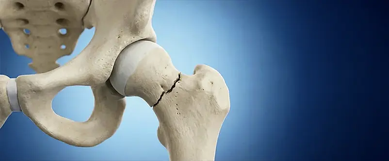 frattura del femore Roma