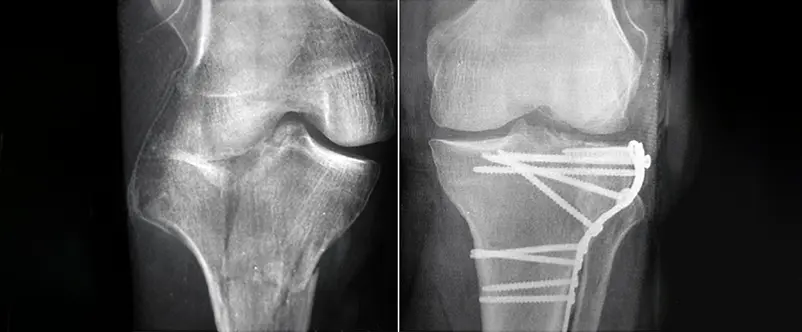 frattura del piatto tibiale roma