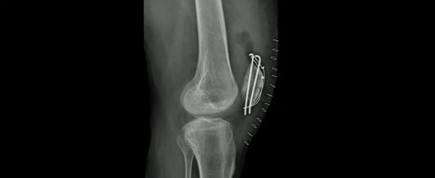 frattura rotula roma