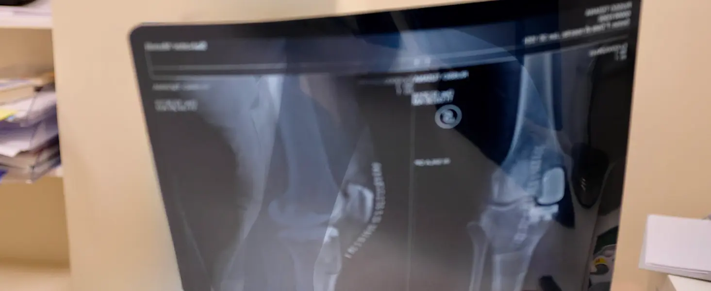 protesi ginocchio paolo lucci