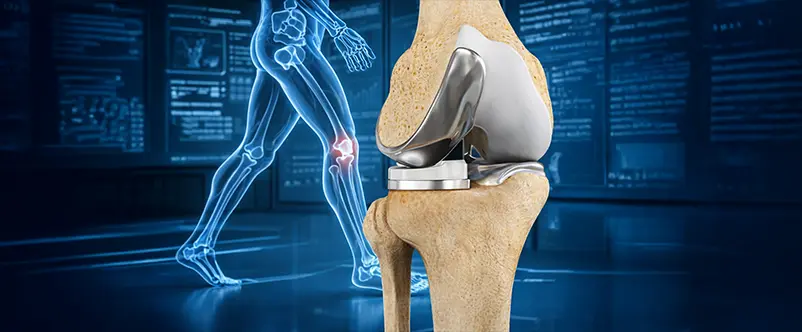 paolo lucci protesi monocompartimentale ginocchio